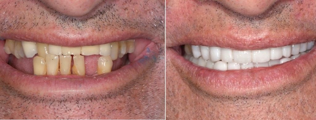 Before and after replacing missing and damaged teeth at Lorn Family and Cosmetic Dentistry in Maitland