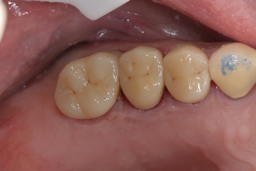 After: teeth restored with new tooth-coloured crowns