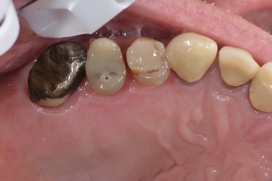 Before: a worn gold crown and cracked, failing back teeth, at Lorn Family and Cosmetic Dentistry in Maitland