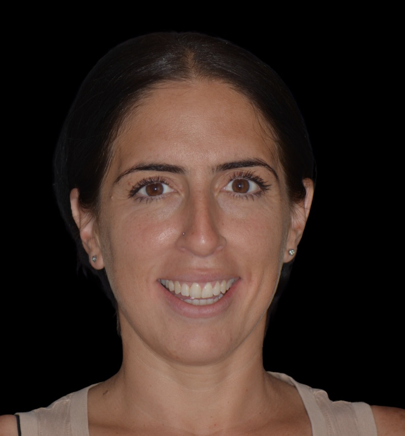 After: straighter, more even teeth following Invisalign clear aligner treatment