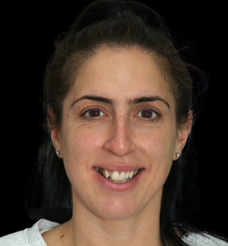 Before: crowded, uneven front teeth, at Lorn Family and Cosmetic Dentistry in Maitland